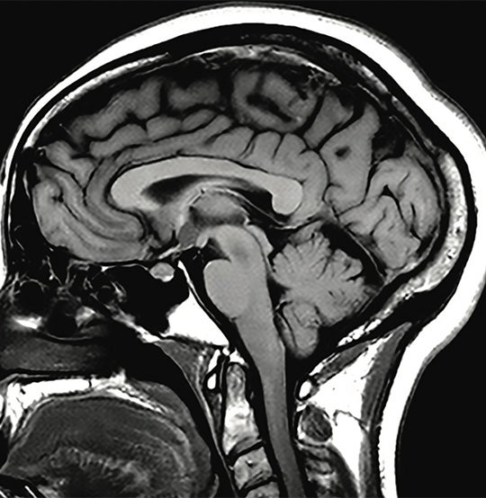 Can I eat before an MRI